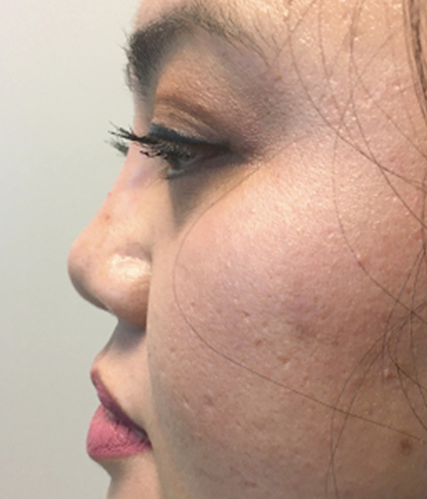 Non Surgical Rhinoplasty 13