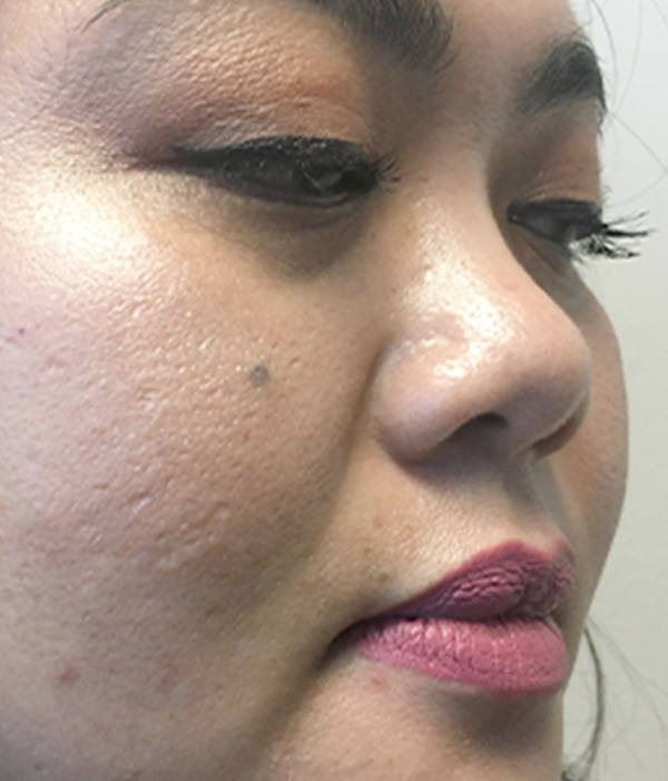 Non Surgical Rhinoplasty 07