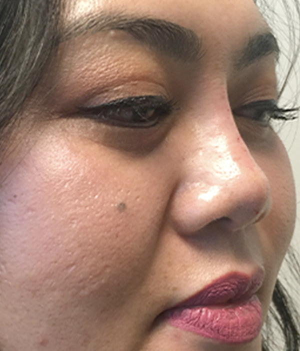 Non Surgical Rhinoplasty 07