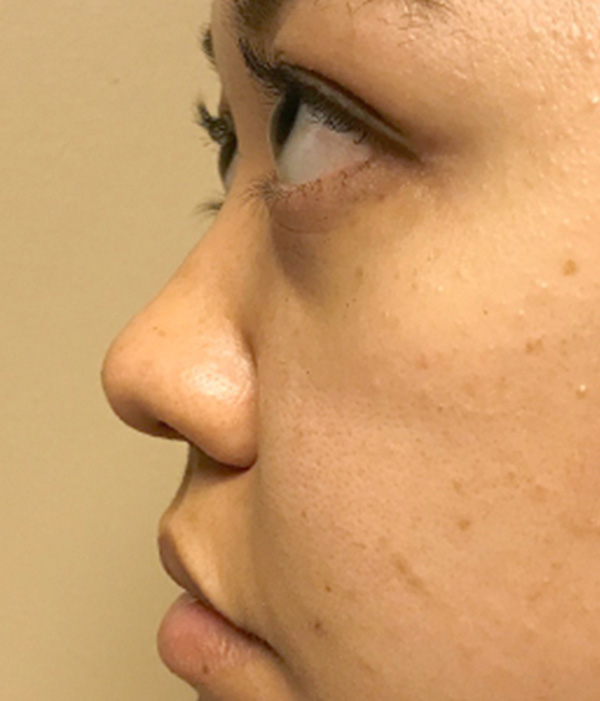 Non Surgical Rhinoplasty 01