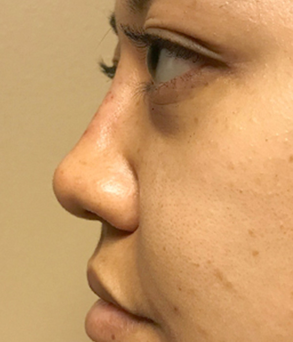 Non Surgical Rhinoplasty 14