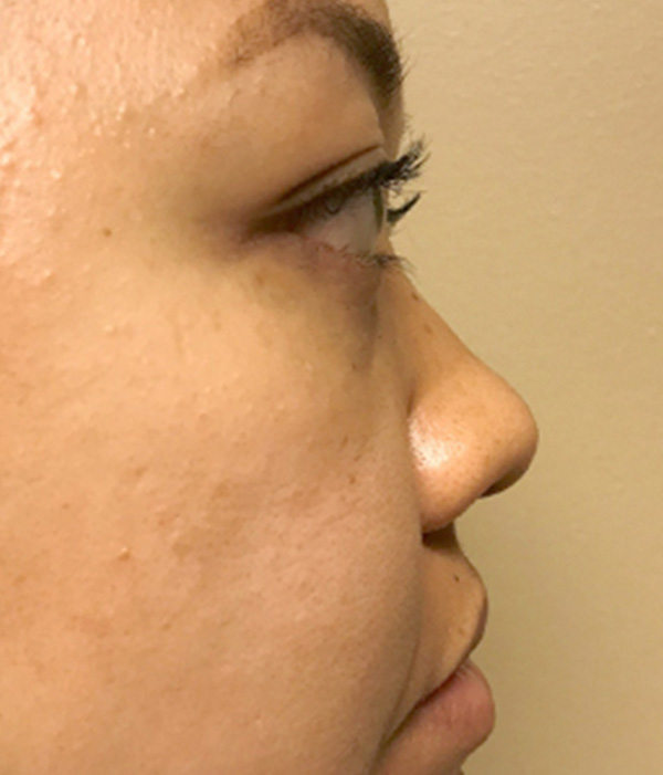 Non Surgical Rhinoplasty 03