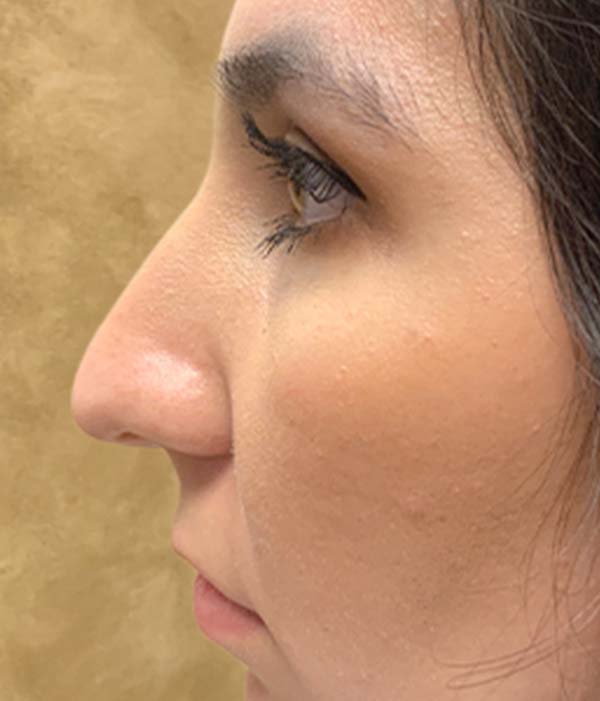 Non Surgical Rhinoplasty 01