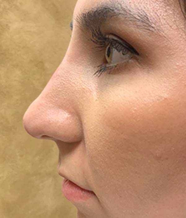 Non Surgical Rhinoplasty 15