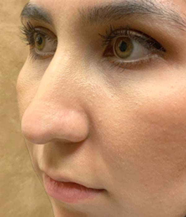 Non Surgical Rhinoplasty 03