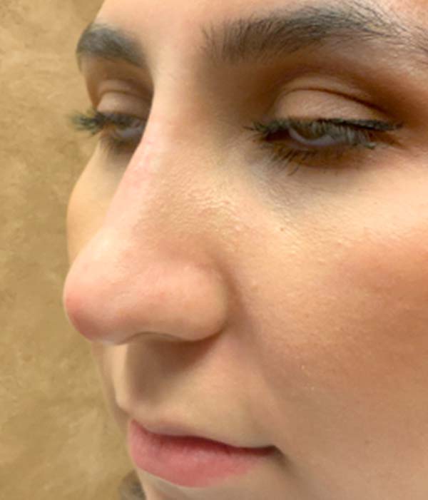 Non Surgical Rhinoplasty 03