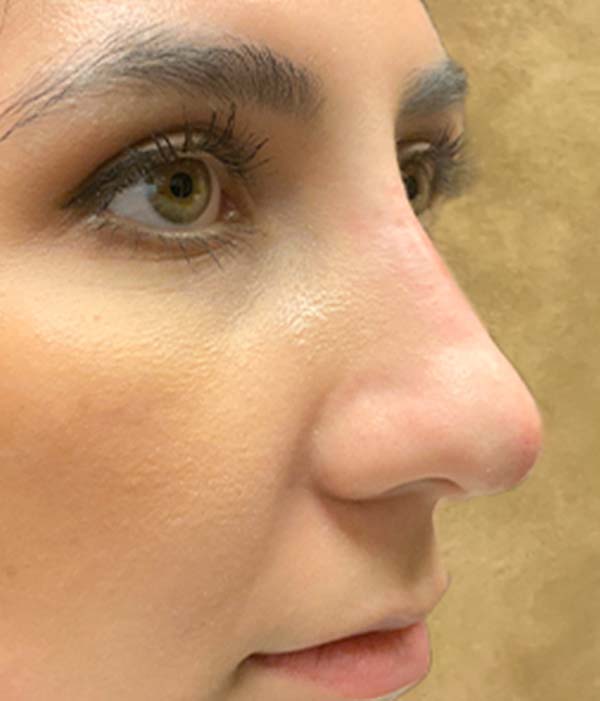 Non Surgical Rhinoplasty 07