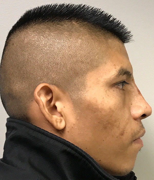 Non Surgical Rhinoplasty 16