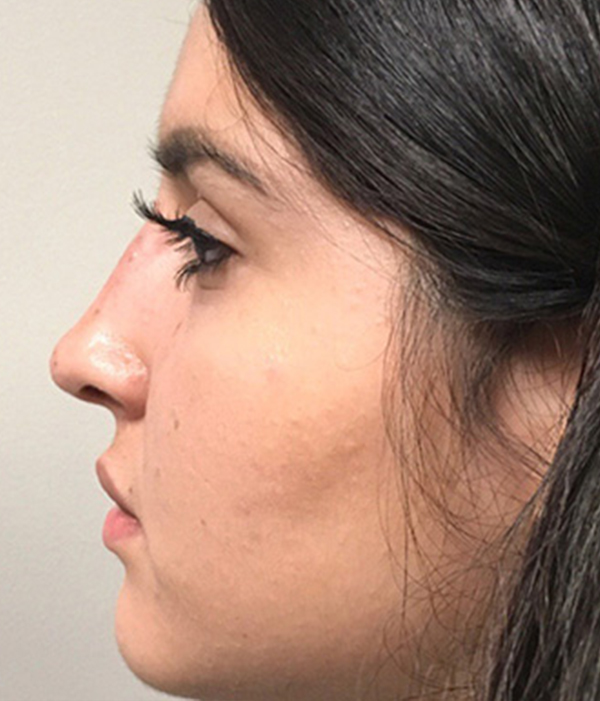 Non Surgical Rhinoplasty 17