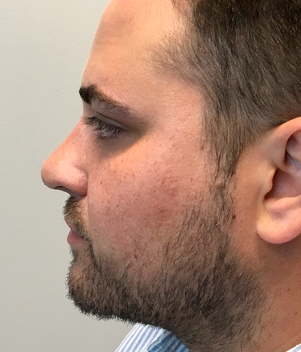 Non Surgical Rhinoplasty 18