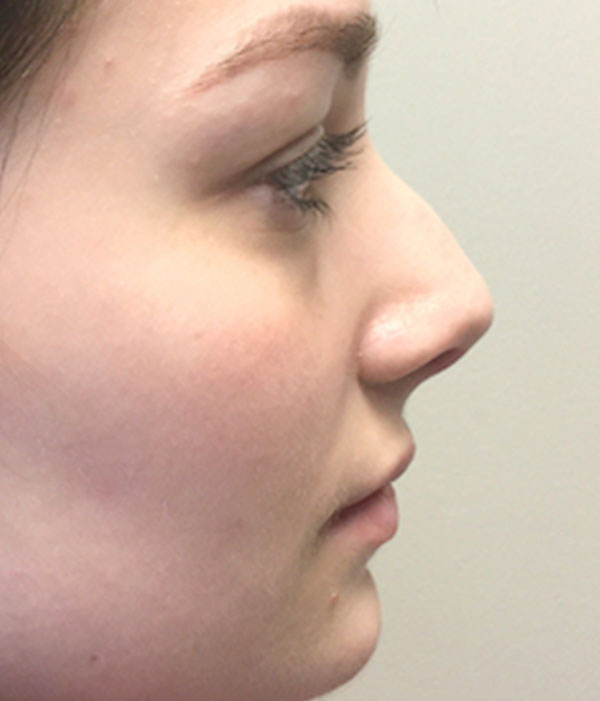 Non Surgical Rhinoplasty 01