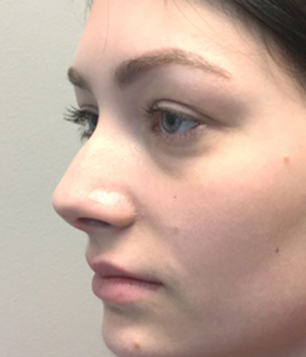 Non Surgical Rhinoplasty 03