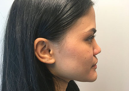 Non Surgical Rhinoplasty 01