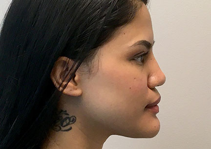 Non Surgical Rhinoplasty 01