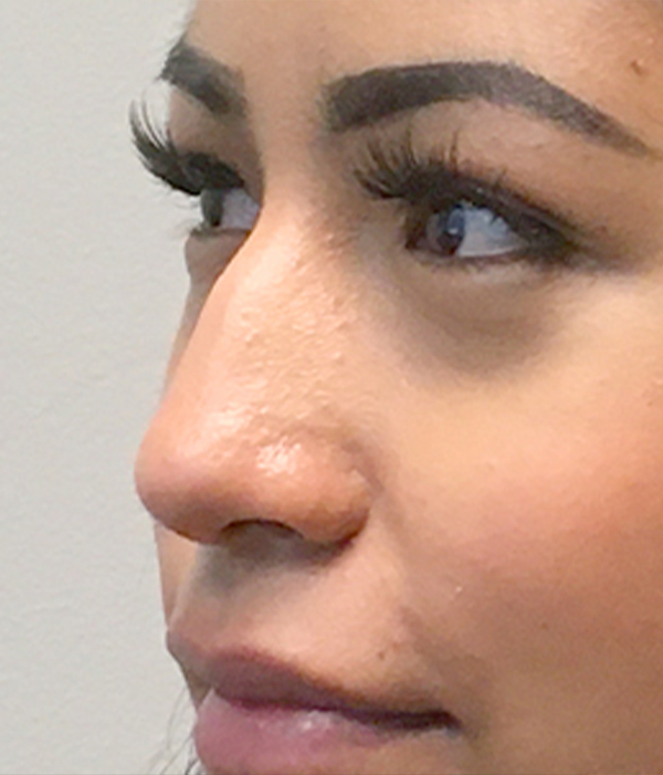 Non Surgical Rhinoplasty 01