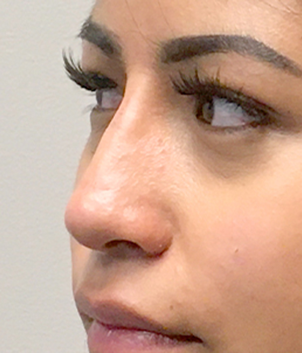 Non Surgical Rhinoplasty 21
