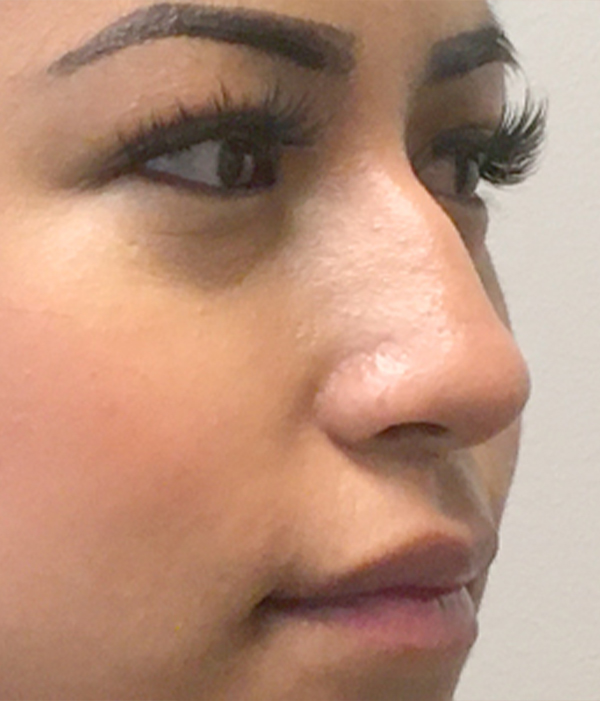 Non Surgical Rhinoplasty 03