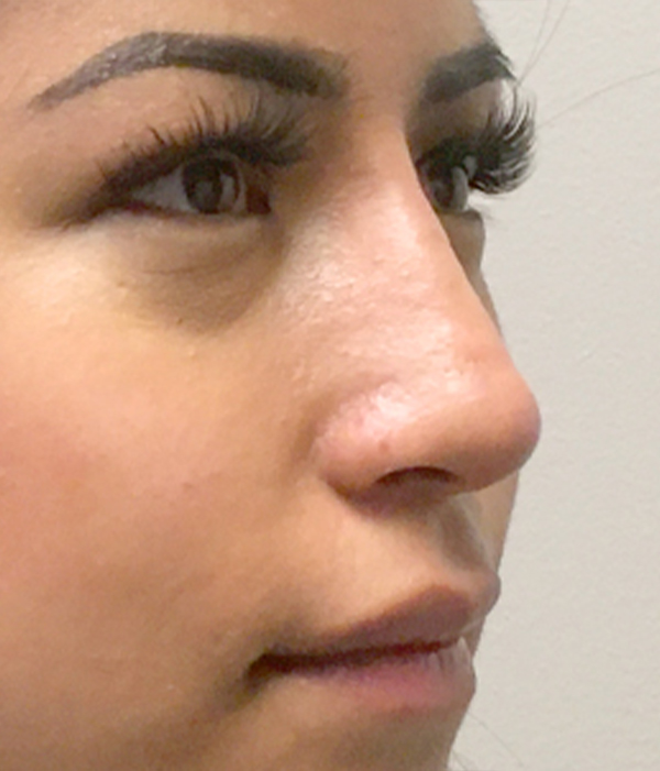 Non Surgical Rhinoplasty 03