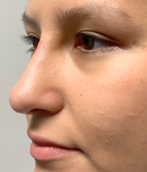 Non Surgical Rhinoplasty 22