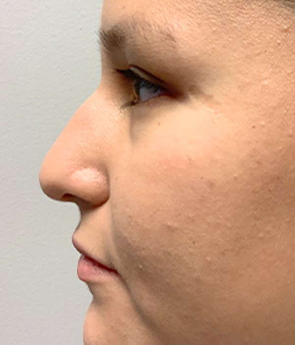 Non Surgical Rhinoplasty 03