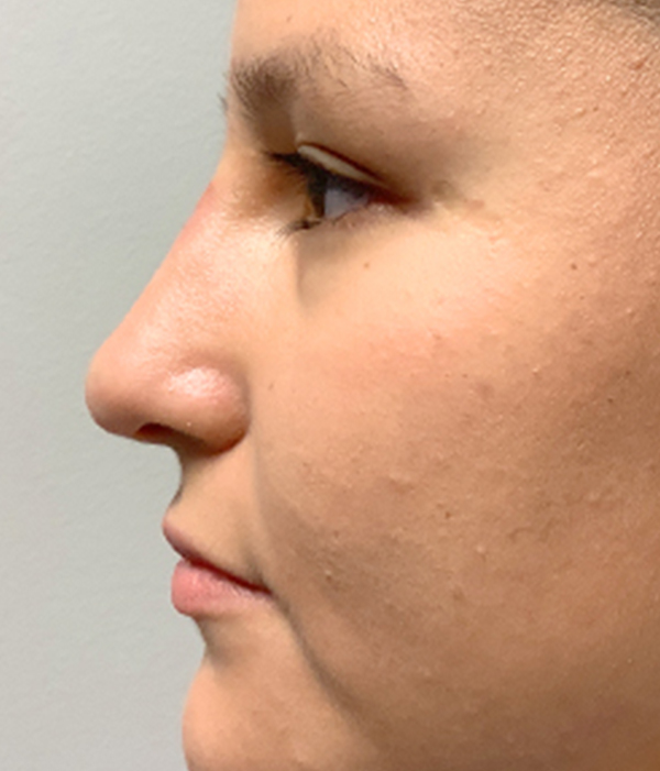 Non Surgical Rhinoplasty 03