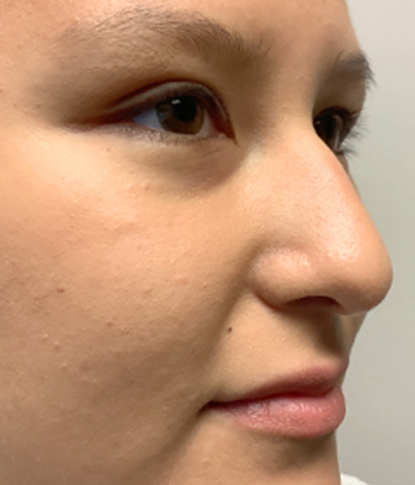 Non Surgical Rhinoplasty 05