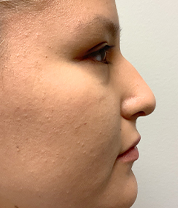 Non Surgical Rhinoplasty 07