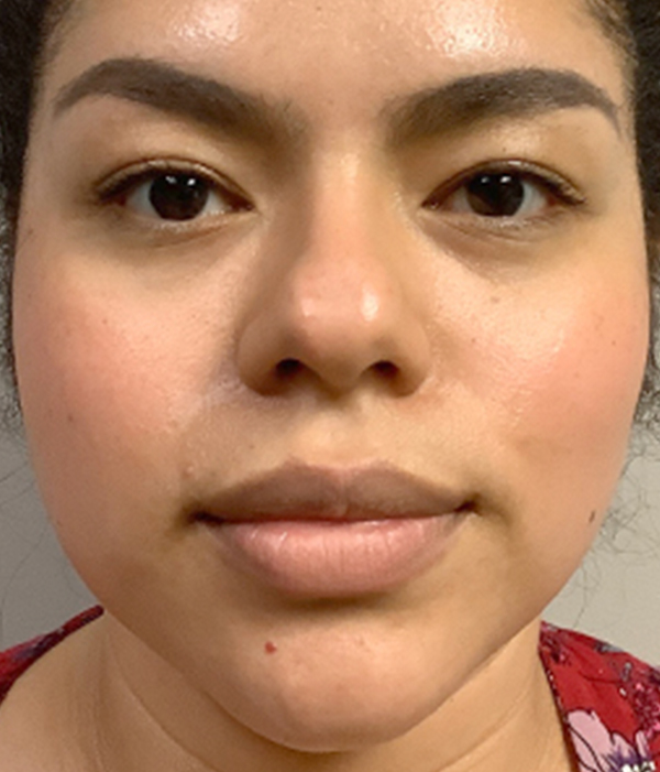 Non Surgical Rhinoplasty 01