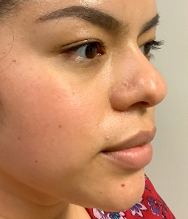 Non Surgical Rhinoplasty 03