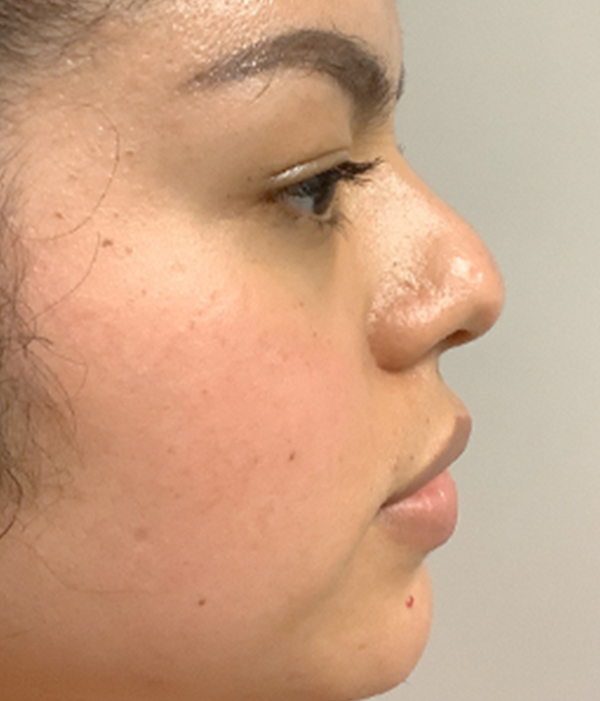 Non Surgical Rhinoplasty 05