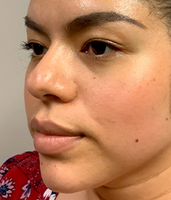 Non Surgical Rhinoplasty 07