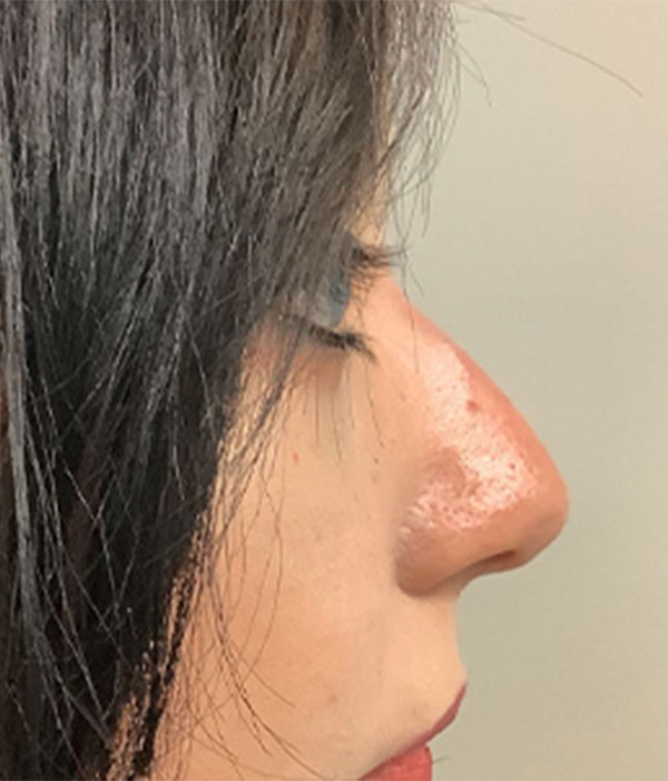 Non Surgical Rhinoplasty 01