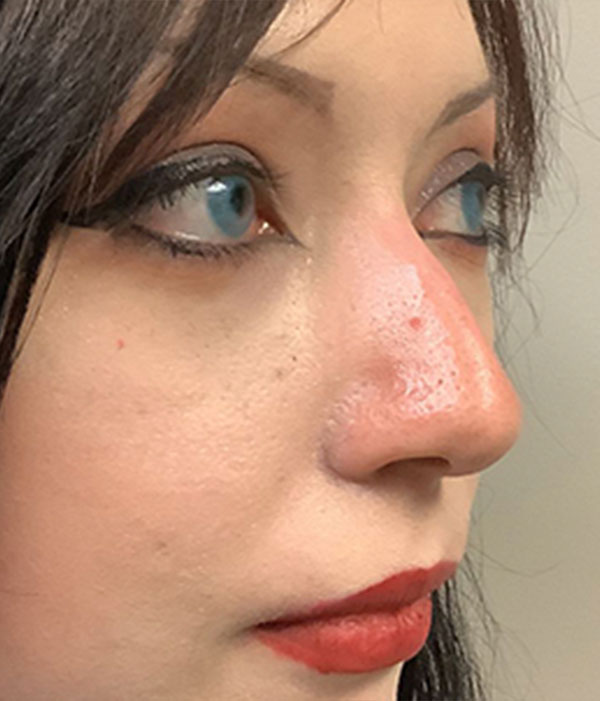 Non Surgical Rhinoplasty 03