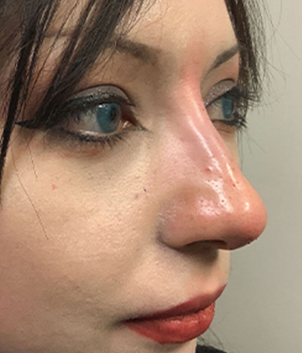 Non Surgical Rhinoplasty 03