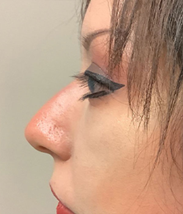 Non Surgical Rhinoplasty 07