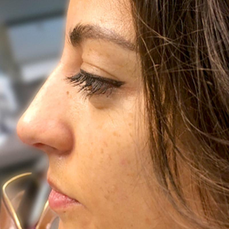 Non Surgical Rhinoplasty 25