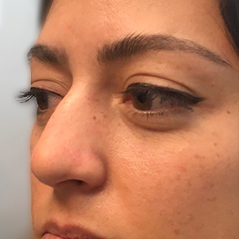 Non Surgical Rhinoplasty 03