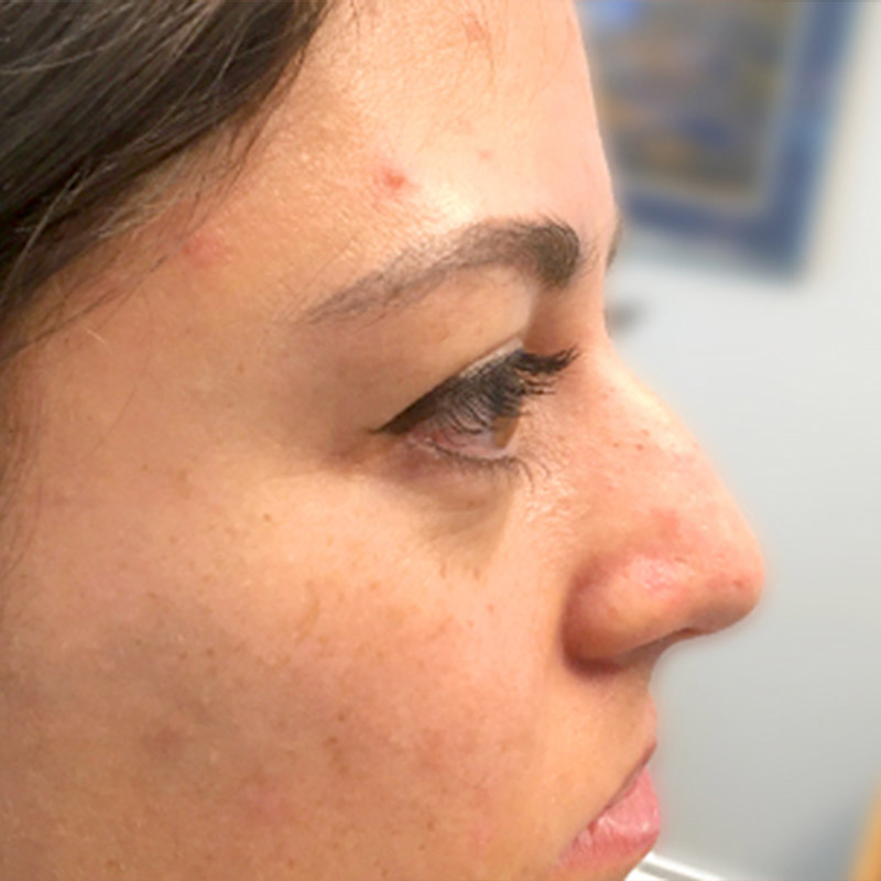 Non Surgical Rhinoplasty 05