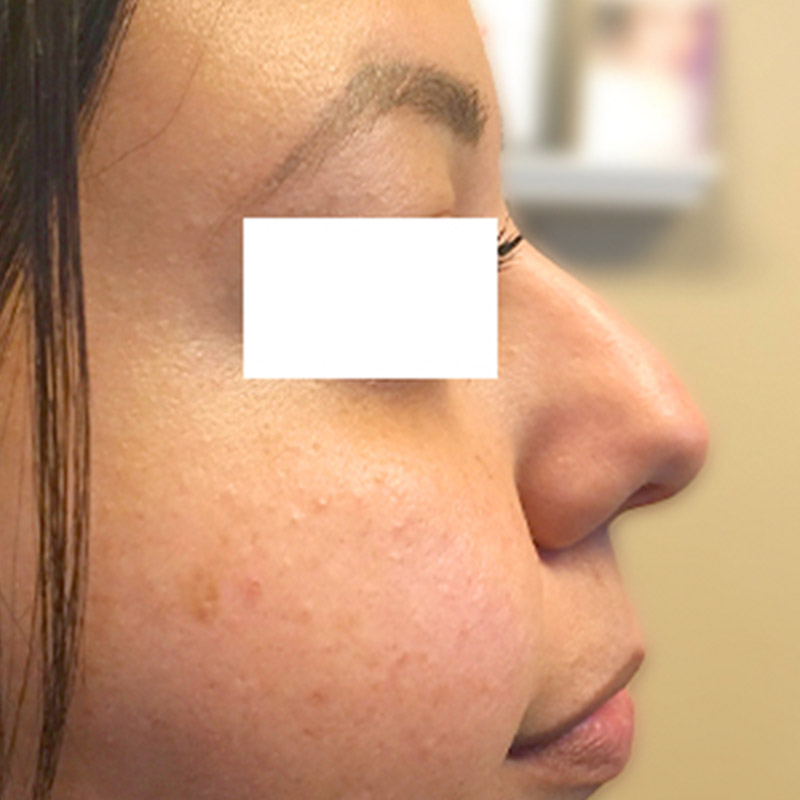 Non Surgical Rhinoplasty 01