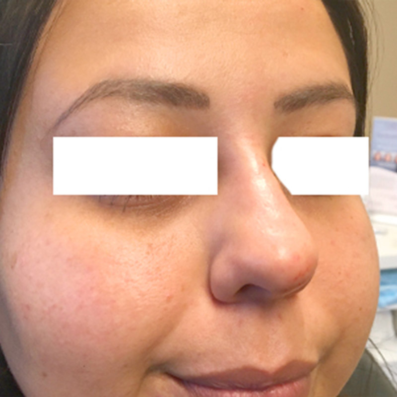 Non Surgical Rhinoplasty 03
