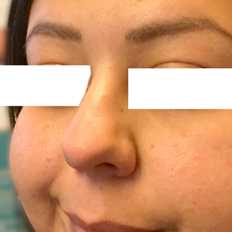 Non Surgical Rhinoplasty 05