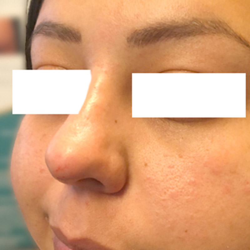 Non Surgical Rhinoplasty 05