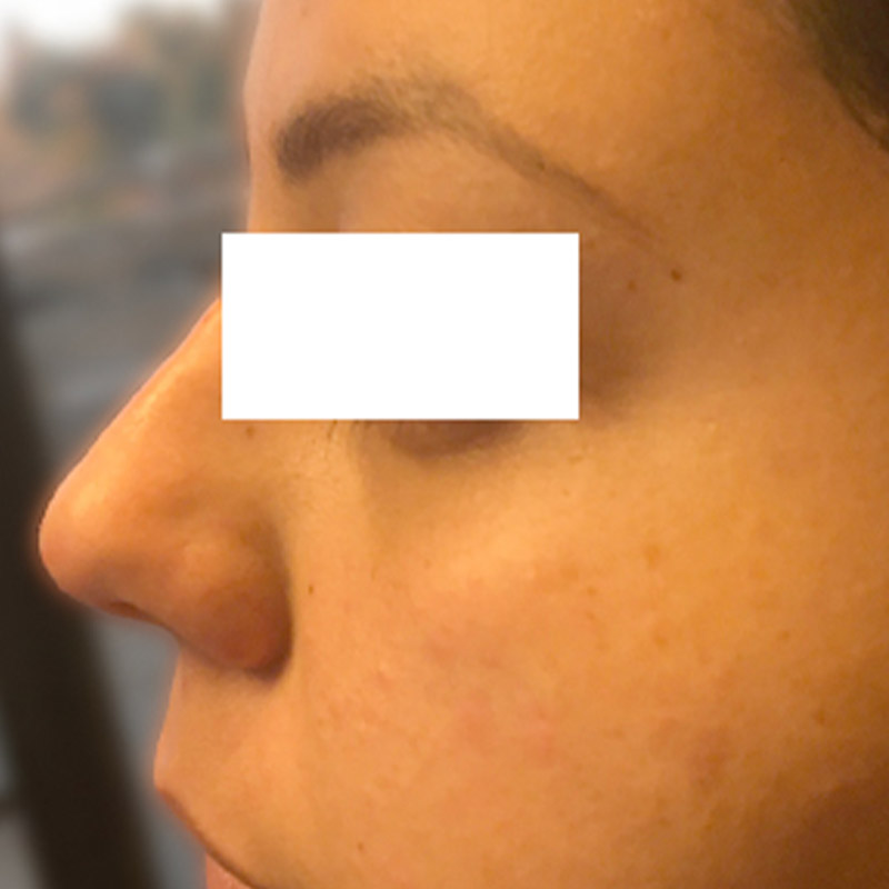 Non Surgical Rhinoplasty 07
