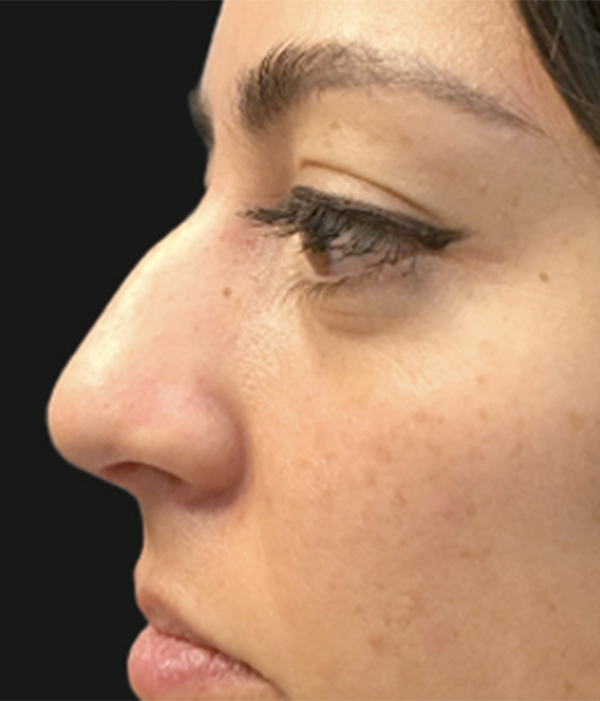 Non Surgical Rhinoplasty 01