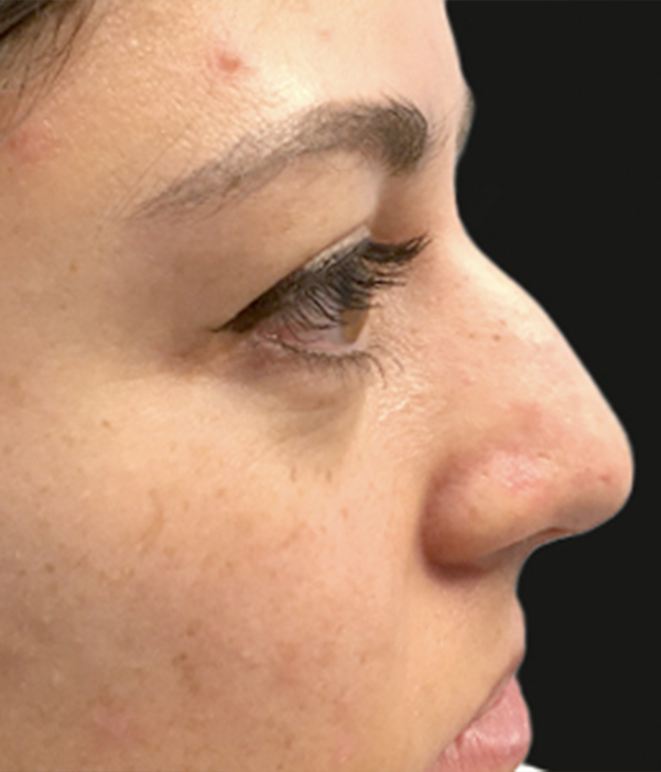 Non Surgical Rhinoplasty 03