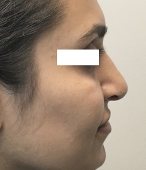 Non Surgical Rhinoplasty 03
