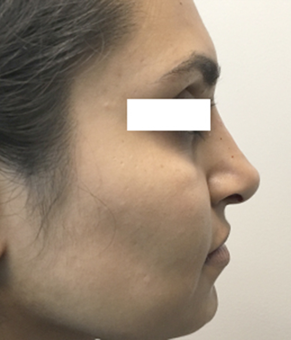 Non Surgical Rhinoplasty 03