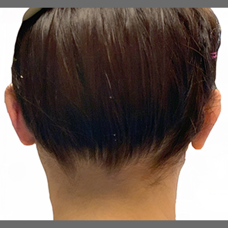 Otoplasty 02