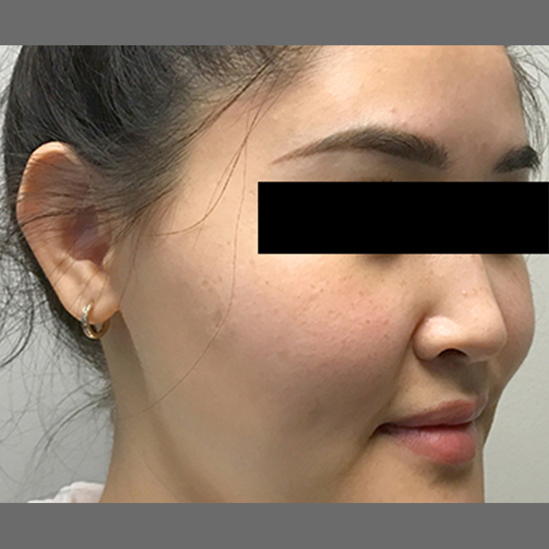 Otoplasty 03