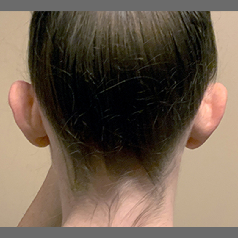 Otoplasty 03